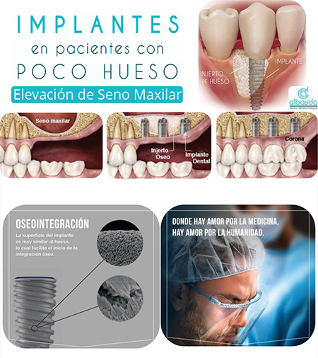 implantes-en-pacientes-con-poco-hueso